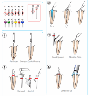 89100_Rel Dentatus prosedyre 3.png